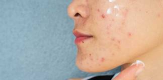 3 Things You Can Do to Reduce Acne Flare-Ups