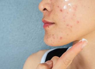 3 Things You Can Do to Reduce Acne Flare-Ups