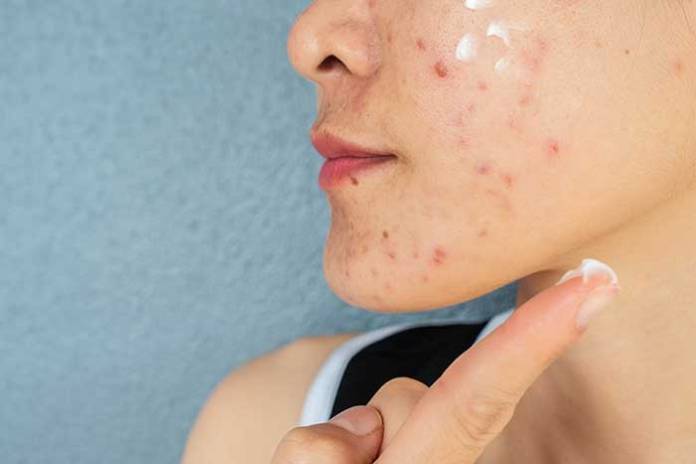 3 Things You Can Do to Reduce Acne Flare-Ups
