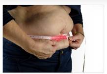 Bariatric Surgery Recommended For Obese Patients with Fatty Liver Problems