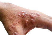 CDC Finds Monkeypox Virus Survives On Household Items and Surfaces