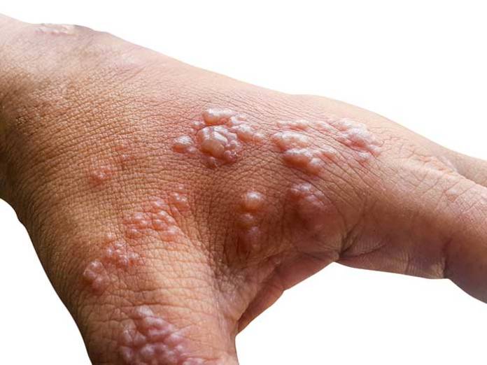 CDC Finds Monkeypox Virus Survives On Household Items and Surfaces
