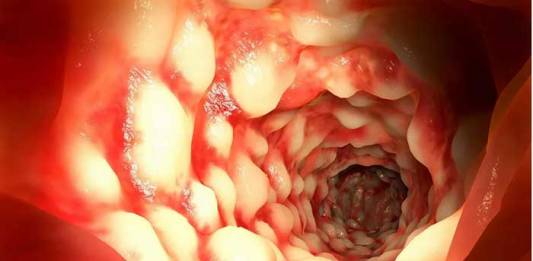 Scientists Discover Why Some People Develop Crohn’s Disease and Others Do Not