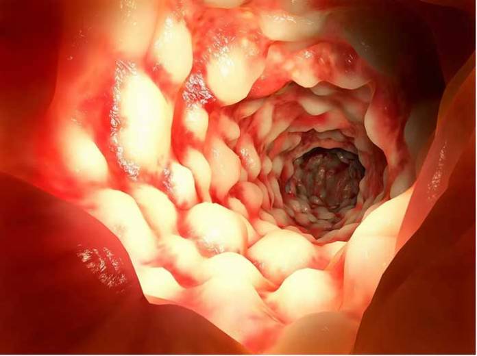 Scientists Discover Why Some People Develop Crohn’s Disease and Others Do Not